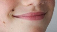 10 biện pháp tẩy nốt ruồi tại nhà không cần tốn tiền đốt điện