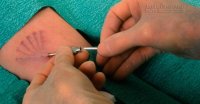Cấy que để tránh thai và những hậu quả bạn không thể ngờ tới