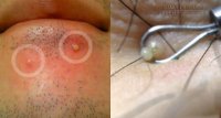 99% người nặn mụn cố lấy bằng được thứ mủ màu trắng mà không biết sự thật kinh hãi này!