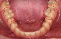 Chủ quan với những đốm đen trên răng, đây là những gì bạn sẽ được nhận lại!