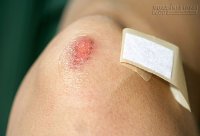 5 thói quen đơn giản giúp da liền sẹo nhanh chóng