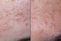 Lương Y ra tay trị mụn lâu ngày bằng phương pháp bí truyền