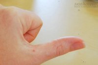 Đánh bay mụn cóc, mụn cơm vĩnh viễn chỉ trong 7 ngày không đau đớn