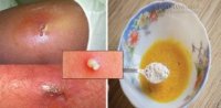 4 cách trị mụn mủ cấp tốc chỉ sau một đêm ngay tại nhà