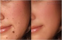 Tự tẩy nốt ruồi ngay tại nhà – đảm bảo hết chỉ với muối