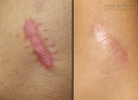 Vết sẹo lồi cứng đầu cũng phải bó tay vì rau má và ngải đắng