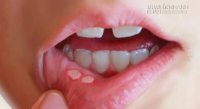 Khỏi ngay nhiệt miệng mà không cần bôi thuốc