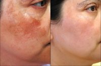 Không cần kem trị nám cũng có được làn da đẹp chỉ với khoai tây