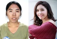 12 màn lột xác gây chấn động giới phẫu thuật thẩm mỹ Thái Lan