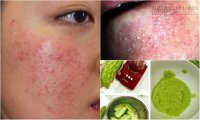 Không ngờ loại quả này lại có thể khiến mụn chìm cũng tự khắc chui lên mà không cần nặn