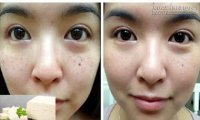 4 cách độc đáo thổi sạch 100% tàn nhang trên mặt được chị em săn lùng