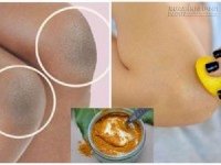Dẹp tan nỗi lo đầu gối thâm đen do cháy nắng ngay tức thì nhờ 3 công thức sau