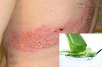 Mẹo chữa zona thần kinh khỏi trong vài ngày