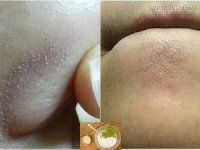 Hướng dẫn chi tiết các bước giúp bạn đẩy nhân mụn dưới da siêu nhanh, siêu hiệu quả trong 7 ngày