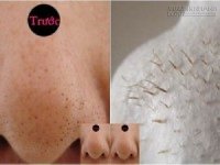 Chỉ với nguyên liệu ai cũng biết này mụn đầu đen sẽ bị lột sạch chưa đầy 5 phút