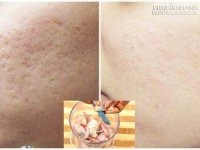 Làm lành sẹo rỗ trên mặt hiệu quả đến 95% chỉ sau 1 tuần