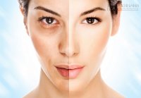 Mẹo trị nám bằng phương pháp đơn giản