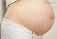 Dù là sinh lần thứ mấy cũng không phải sợ 1 vết rạn nào trong suốt thai kỳ với 2 nguyên liệu cực dễ tìm này