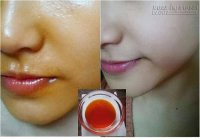 Thoa hỗn hợp này sau 1 tuần làn da đen xì do cháy nắng cũng trở nên trắng hồng