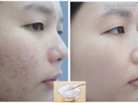 Mẹo xóa thâm mụn cực nhanh, an toàn tuyệt đối tại nhà