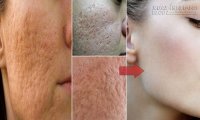 Giảm đáng kể lỗ chân lông to với phương pháp tự nhiên
