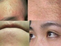 Học ngay bí kíp trị mụn ẩn vĩnh viễn không để lại thâm, sẹo