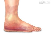 Bong gân cổ tay, cổ chân hết ngay với 2 bài thuốc dân gian cực hiệu quả sau