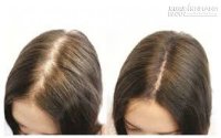 Tóc hết rụng ngay lập tức, mọc dày sau 2 lần áp dụng mẹo này