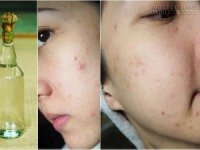 Diệt sạch mụn, dưỡng da trắng hồng chỉ sau 7 ngày chỉ nhờ 1 thìa canh rượu gạo, tin được không?
