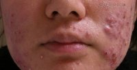 Cách trị mụn dễ ẹt mà một khi đã áp dụng thì chỉ có thành công mỹ mãn