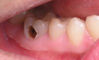 Tiêu diệt ngay vi khuẩn gây sâu răng bằng mẹo dân gian