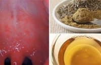 Viêm họng dù nặng đến đâu cũng chào thua bài thuốc chỉ dùng trong 4 giờ là khỏi này