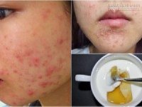 3 bước đánh bay mụn trứng cá chỉ sau 1 đêm áp dụng