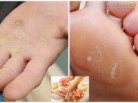 Vết chai chân, chai tay dày và lâu bao nhiêu cũng nhanh chóng biến mất chỉ sau 3 tuần