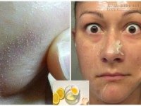 Bí quyết trị mụn cám vĩnh viễn chỉ với nước chanh và sữa ấm bạn nên thử ngay