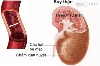 Phát hiện dấu hiệu sớm của bệnh thận để không chết vì thiếu hiểu biết