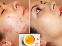 Đây là những công thức trị mụn cấp tốc bạn không biết sẽ tiếc hùi hụi