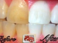 Chỉ với 2 nguyên liệu, bạn đã có ngay công thức giúp răng sáng bóng sau 5 phút