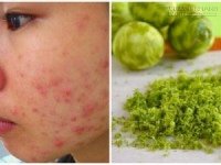 Ngả mũ trước công dụng trị mụn, trắng da siêu tốc của vỏ chanh