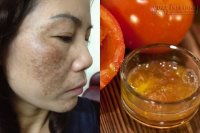 Xóa sổ nám da dù nặng tới cỡ nào chỉ cần 1 ngàn đồng mỗi ngày