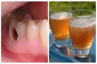 Bài thuốc dân gian trị đau nhức, sâu răng, răng lung lay ê buốt chỉ 1 ngày là dứt