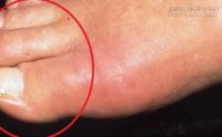 8 dấu hiệu cảnh báo suy thận