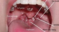 Nếu thấy dấu hiệu này 100% bạn đã bị ung thư vòm họng