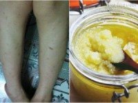 Thổi bay sẹo thâm do muỗi đốt ở chân trong tích tắc giúp nàng tha hồ diện váy