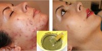 Học ngay tuyệt chiêu trị mụn thần tốc với đậu xanh chỉ trong 5 ngày