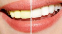 Răng không những hết ố vàng mà còn trắng sáng đều như hạt bắp nhờ công thức từ một lọ oxy già