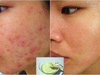 Chỉ cần thoa hỗn hợp này trong 5 phút mụn trứng cá sẽ bị đánh bay trong 5 ngày