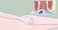 Dấu hiệu nguy hiểm chắc chắn bạn đã bị ung thư hậu môn