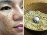 Nám nhiều và lâu năm đến đâu cũng bị xóa nhòa 90% nhờ đậu phụ non