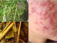 3 công thức xông hơi vừa giúp da không bao giờ lo nổi mụn mà còn trắng lên 2 tông chỉ sau 7 ngày